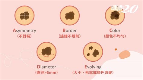 大黑痣|別把癌當痣！5部位冒黑點恐是惡性黑色素瘤 台大醫師。